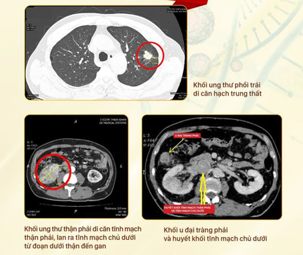 3 khối ung thư riêng biệt mà các bác sĩ Thiện Nhân Đà Nẵng chẩn đoán, phát hiện cho bệnh nhân N.X.C.