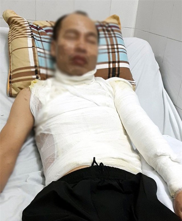 Hà Nội: Bé gái 9 tuổi hoảng loạn vì bố bị tạt axit ngay trước mặt