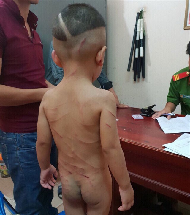 Bé 3 tuổi bị cha dượng đánh dã man: Nạn nhân thương tật 24%