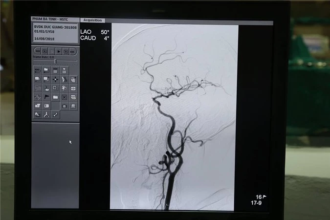 Hình ảnh chụp mạch não của bệnh nhân Phạm B.T. Ảnh: Bệnh viện cung cấp.