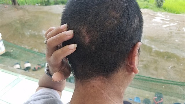 Vụ bạo hành người giúp việc: Nạn nhân khai nhiều hình thức bị tra tấn