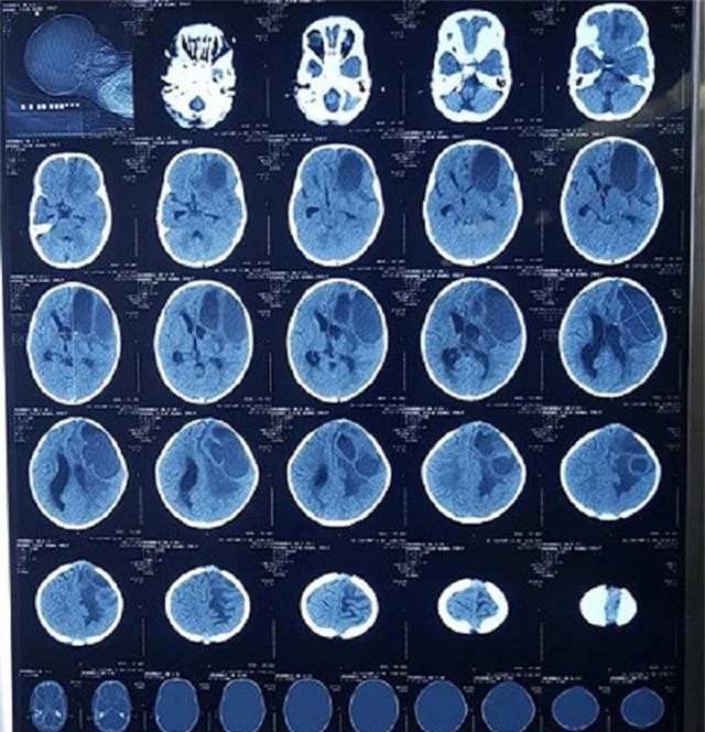 Hình ảnh chụp CT bệnh nhân áp xe não. (Ảnh: BV Hữu nghị VIệt Nam - Cu Ba Đồng Hới)