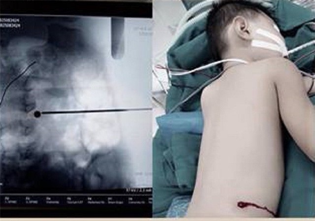 Bé trai nghịch súng bắn chim, đạn xuyên lưng nằm trong đĩa đệm