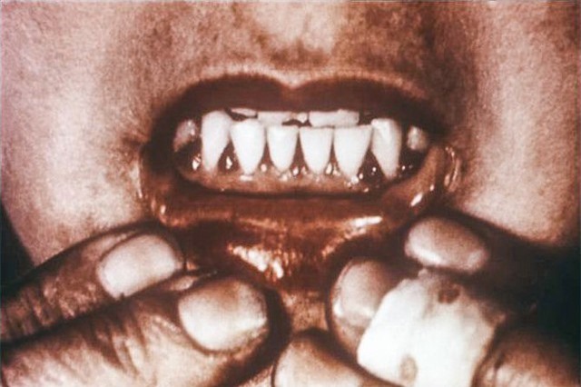 Căn bệnh bí ẩn từng giết hàng loạt hải tặc vào thế kỷ 18 đang dần xuất hiện