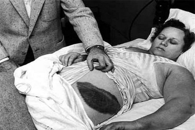 Người phụ nữ bị thiên thạch rơi trúng người