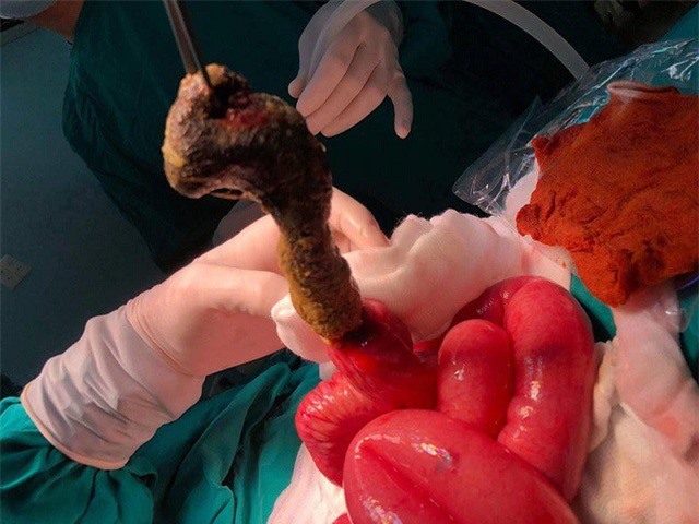 Mắc hội chứng “công chúa tóc mây” bé 6 tuổi tắc ruột