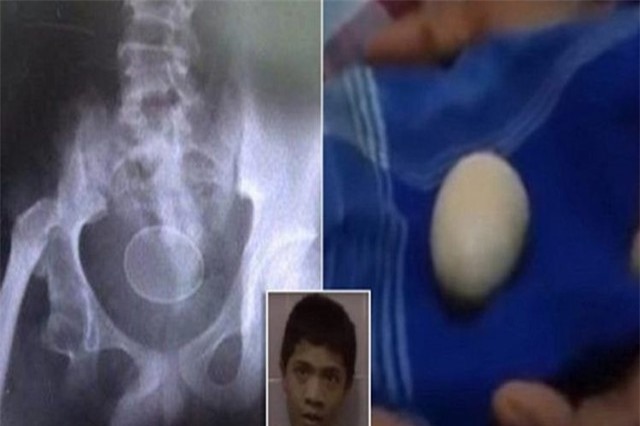 Sự thật gây sốc về cậu bé biết đẻ trứng ở Indonesia