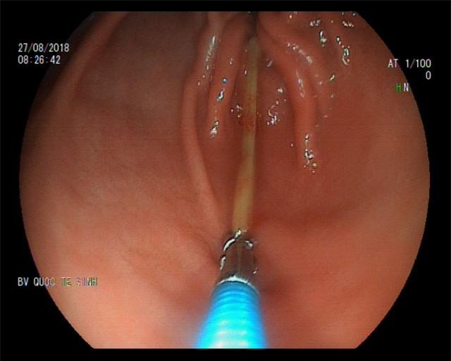 Ngủ quên, nuốt tăm dài 7cm vào bụng