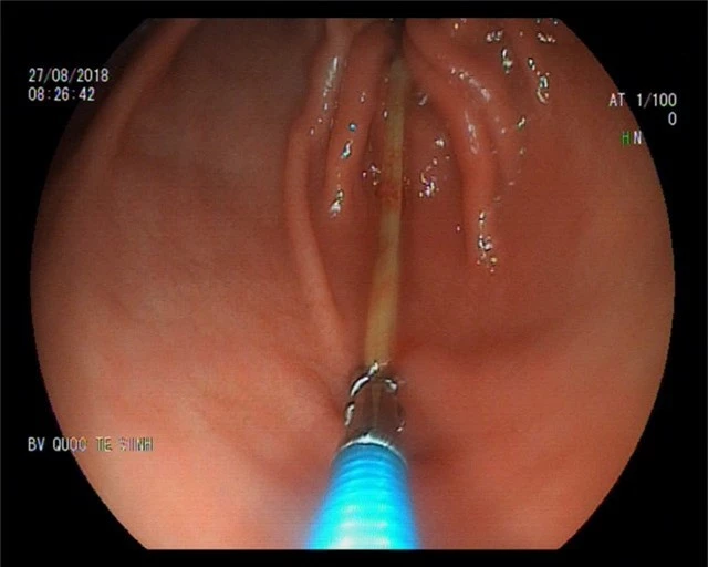 Hình ảnh nội soi chiếc tăm trong dạ dày của bệnh nhân.