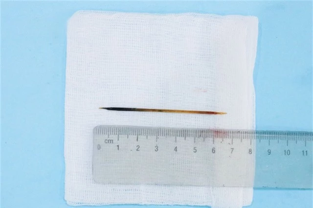 Chiếc tăm dài 7cm được lấy ra từ dạ dày bệnh nhân.