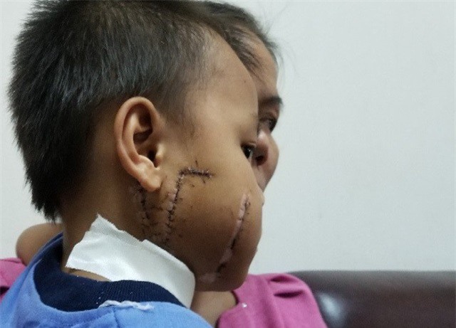 Bé 6 tuổi bị quạt công nghiệp "cắt" vào mặt