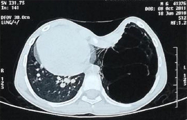 Bé 7 tuổi tức ngực, phát hiện tim nằm bên phải