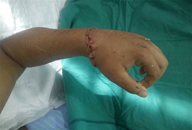 9X bị chém đứt lìa cánh tay khi đến quán hát