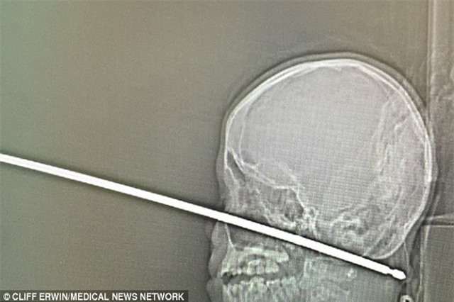 Bị thanh sắt xuyên thủng sọ, bé trai 10 tuổi sống sót kỳ diệu