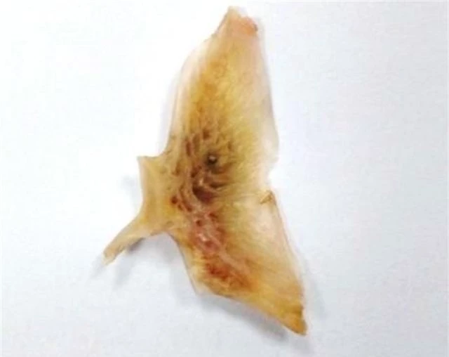 Xương cá ngát được lấy ra từ thực quản bệnh nhân. (Ảnh: BV Thanh Vũ Bạc Liêu)