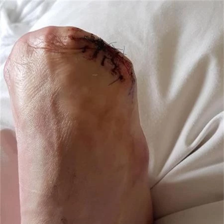 Cô gái chụp lại bàn chân sau cuộc phẫu thuật cắt bỏ ngón chân còn lại cuối cùng
