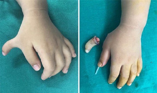 Trẻ bị dị tật 6 ngón tay, cha mẹ phải làm gì?