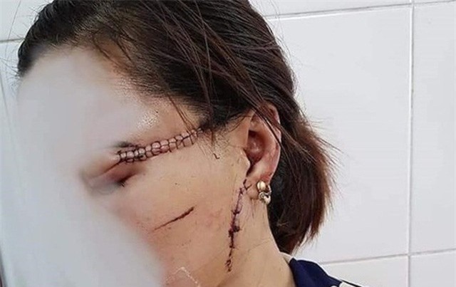 Chồng hờ dùng dao rạch mặt, cắt gân chân vợ vì ghen