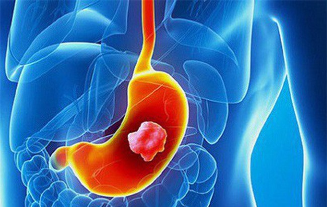 Giật mình trước con số người mắc ung thư dạ dày mỗi năm ở Việt Nam