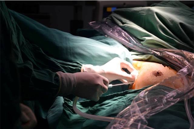 Việt Nam là nước đầu tiên thành công nội soi tuyến giáp một lỗ