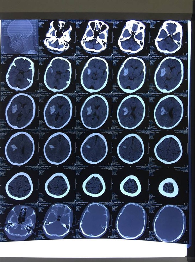 Kịch tính 3 giờ mở sọ cứu sống bệnh nhân xuất huyết não 