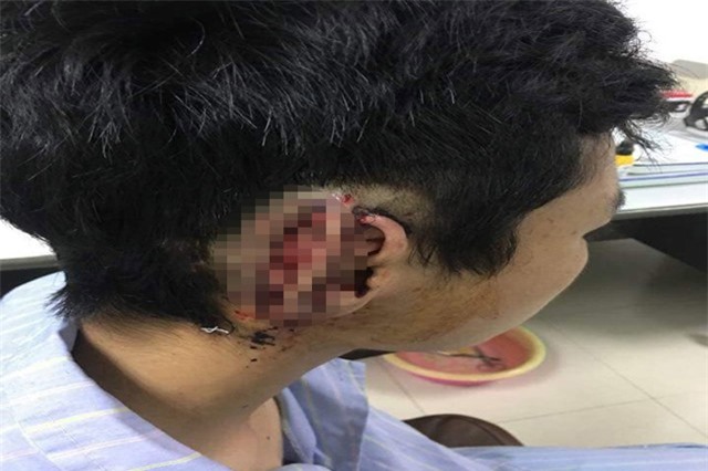 Nam sinh bị bạn cắn đứt tai và nuốt vào bụng