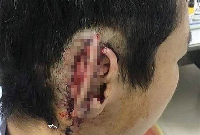 Ðiều tra vụ nghi vấn 'phê cỏ Mỹ' cắn đứt tai bạn