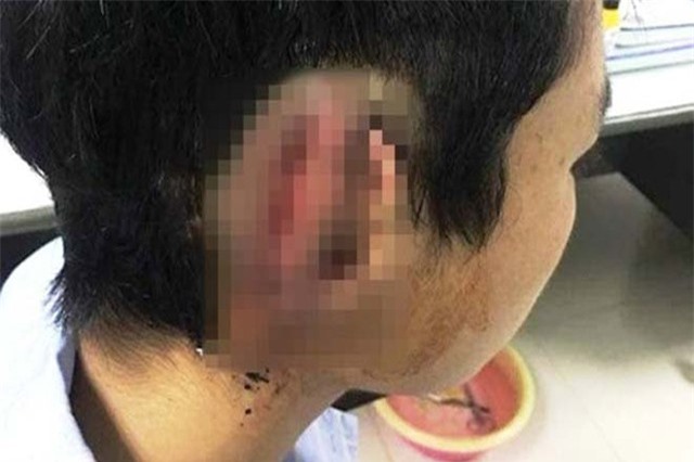 Đã có kết quả xét nghiệm ma túy với nam sinh cắn đứt tai bạn