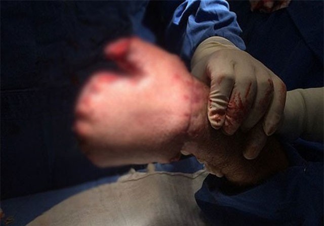 Bác sĩ khâu tay người đàn ông vào dạ dày và cái kết bất ngờ