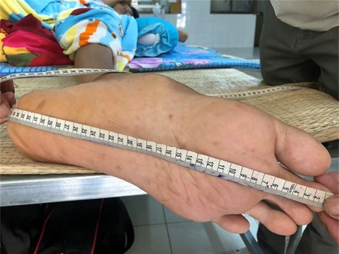 Nỗi khổ của bệnh nhân cao 2,5 mét ở Cà Mau - ảnh 2