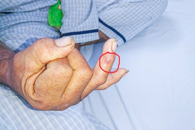 Nhiều người miền Tây bị rắn độc cắn trong mùa lũ