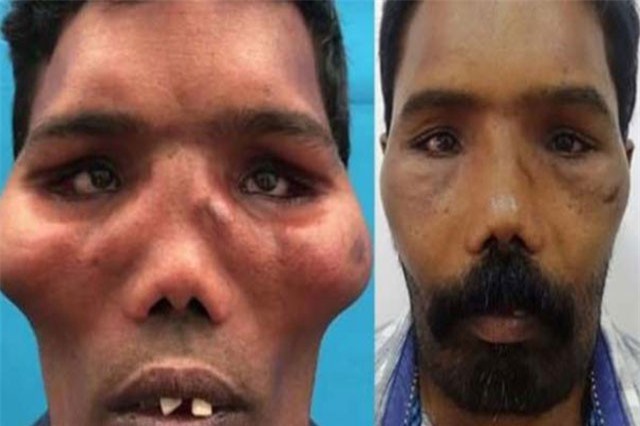 Hội chứng mặt sư tử hiếm gặp, người đàn ông này bị tất cả mọi người kinh sợ