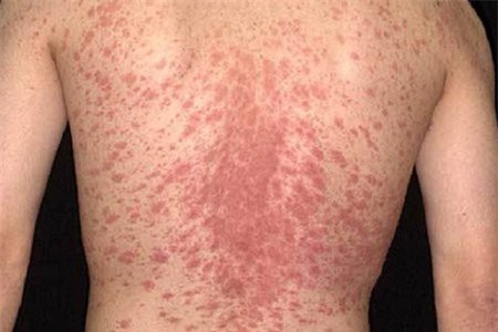 Bệnh vẩy nến: Hiểu đúng hơn để có cái nhìn tích cực trong điều trị và phòng tránh