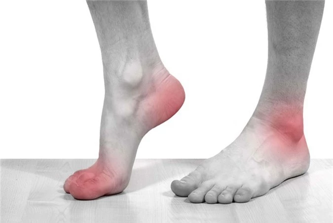 Bệnh gout. Ảnh minh họa. Bệnh gout. Ảnh minh họa.