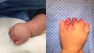 Kỳ tích bé ngoại quốc bị dính ngón bẩm sinh được phẫu thuật thành công