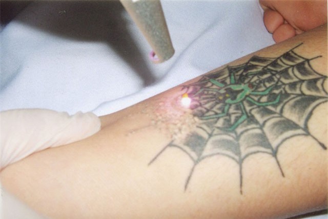 Clip: Tìm hiểu cơ chế xóa hình xăm bằng tia laser