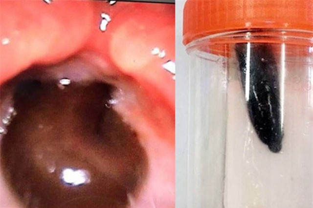 Con đỉa dài 5cm sống trong cổ họng bé gái suốt 2 tháng