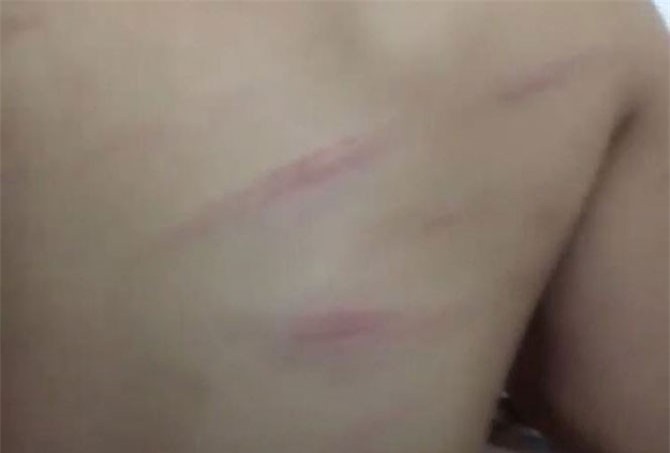 Bé gái bị cô giáo chủ nhiệm đánh bầm tím lưng vì lười học