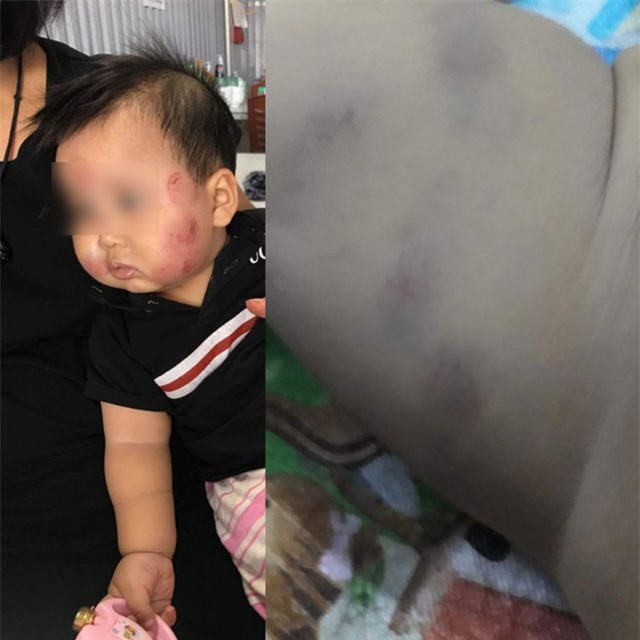 Bé 1 tuổi bầm tím đầy người khi đi gửi trẻ ở Bắc Giang