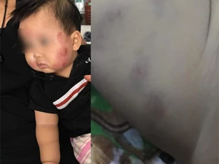 Bé 1 tuổi bầm tím đầy người khi đi gửi trẻ ở Bắc Giang