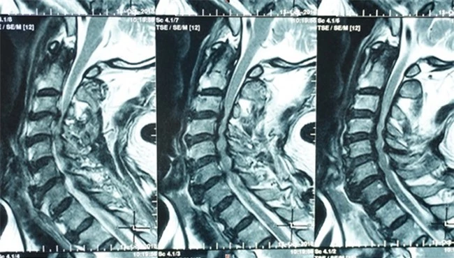 Hình phim MIR cột sống cổ của bệnh nhân P.Đ.T. (ảnh BM)