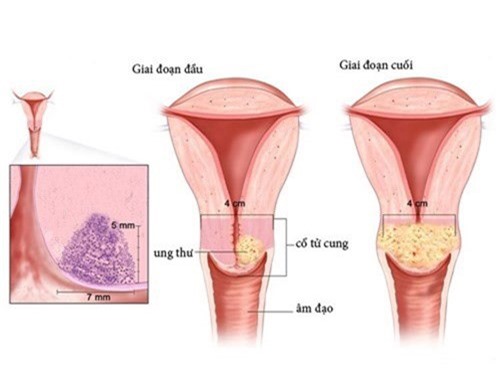 4 buoc phat hien som ung thu co tu cung hinh anh 1