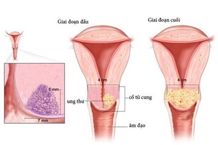 4 bước phát hiện sớm ung thư cổ tử cung