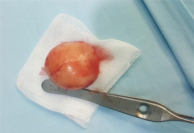 Cắt bỏ tinh hoàn thứ... 3 cho người đàn ông