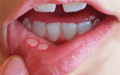 Clip: 'Bí kíp' chữa nhiệt miệng không cần thuốc nhanh chóng ngay tại nhà