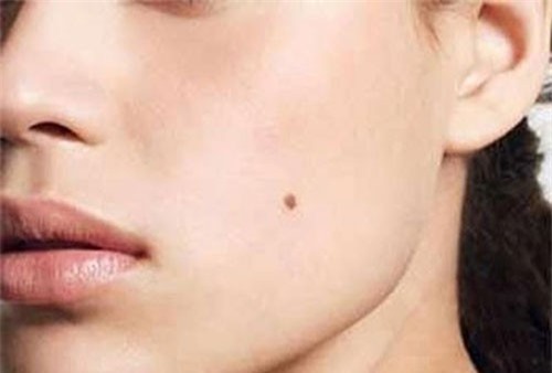 Cực kỳ nguy hiểm khi bị ung thư từ ... nốt ruồi