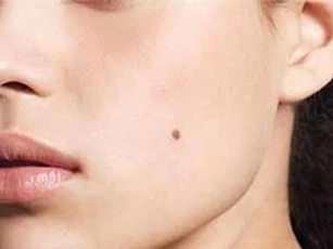 Cực kỳ nguy hiểm khi bị ung thư từ ... nốt ruồi