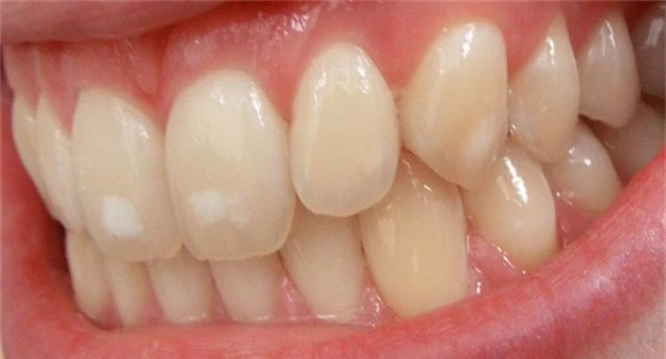Mảng trắng trên răng Đây là dấu hiệu của bệnh nhiễm fluorosis.