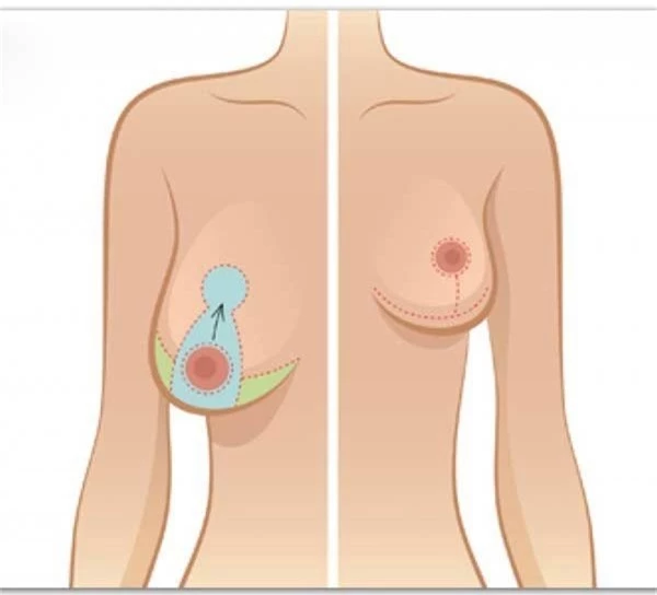 Ngực “quả mướp” và những lầm tưởng của hầu hết mọi người