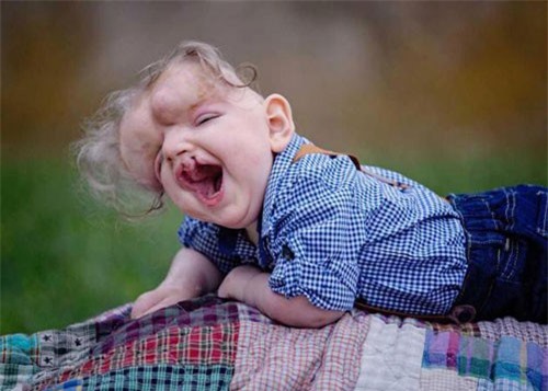 Em bé khuyết sọ đón sinh nhật đầu tiên trong đời